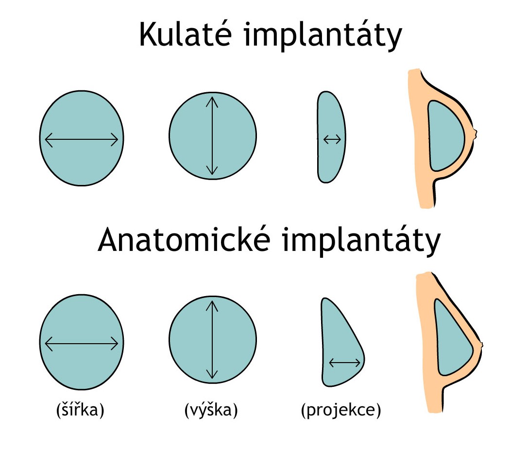 Typy prsních implantátů
