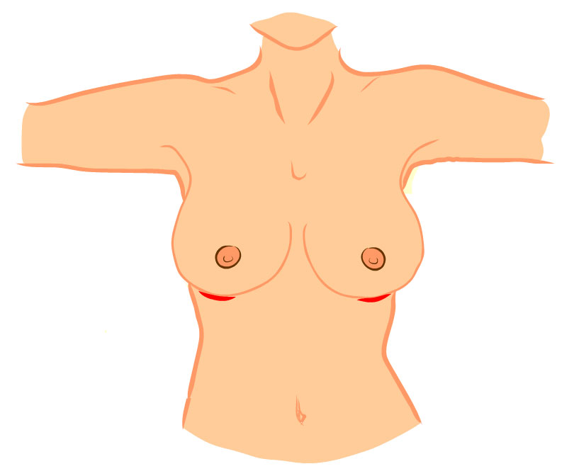 místa vedení řezu