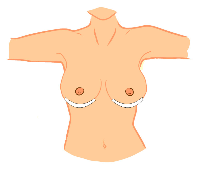 Zvětšení prsů zalepení ran