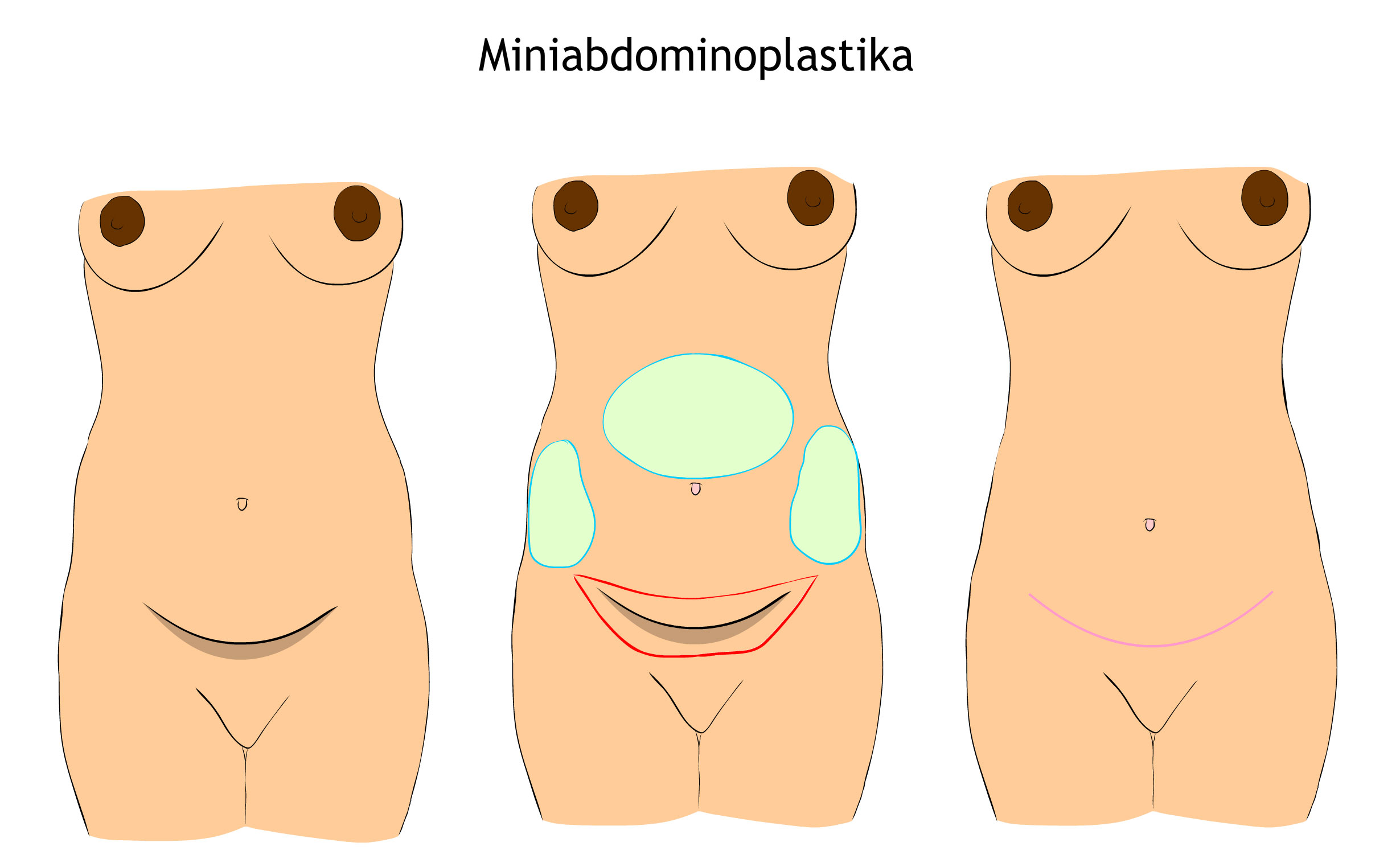 Miniabdominoplastika
