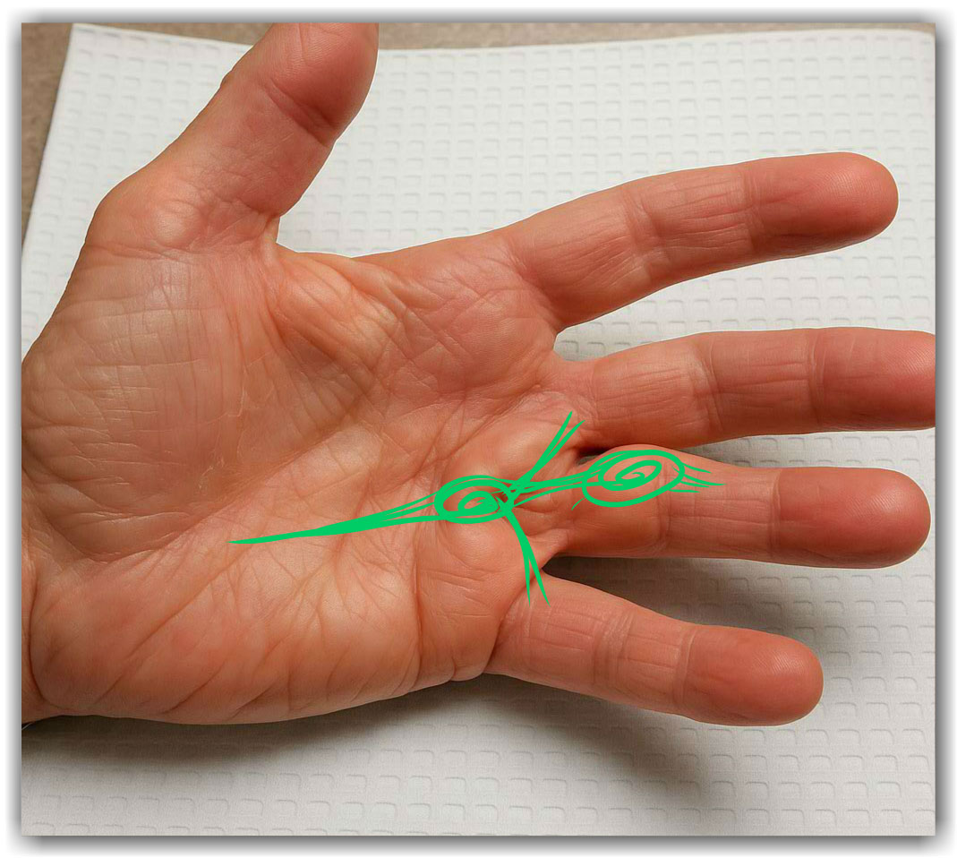 Dupuytrenova kontraktura