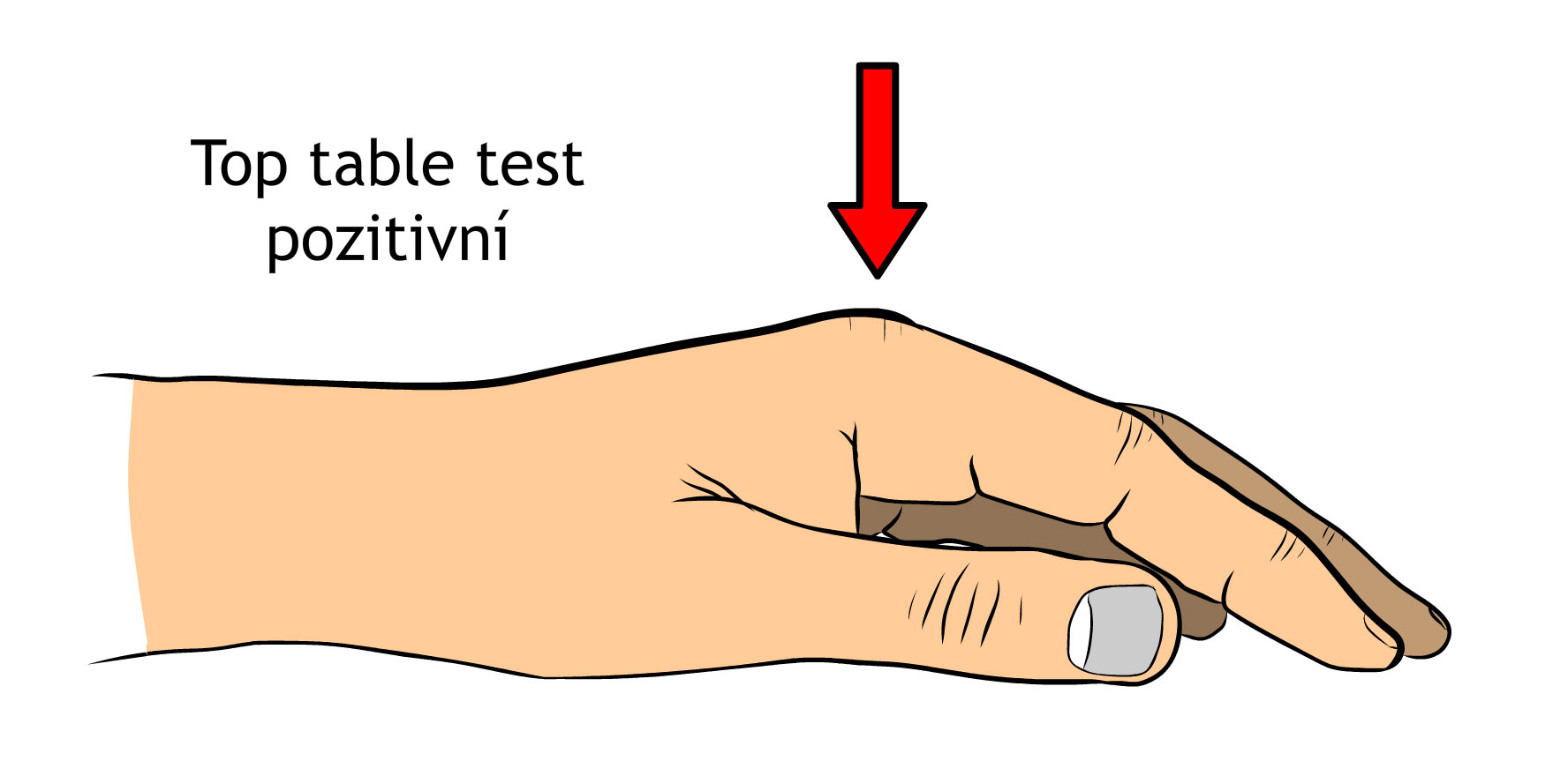 Dupuytrenova kontraktura table top test