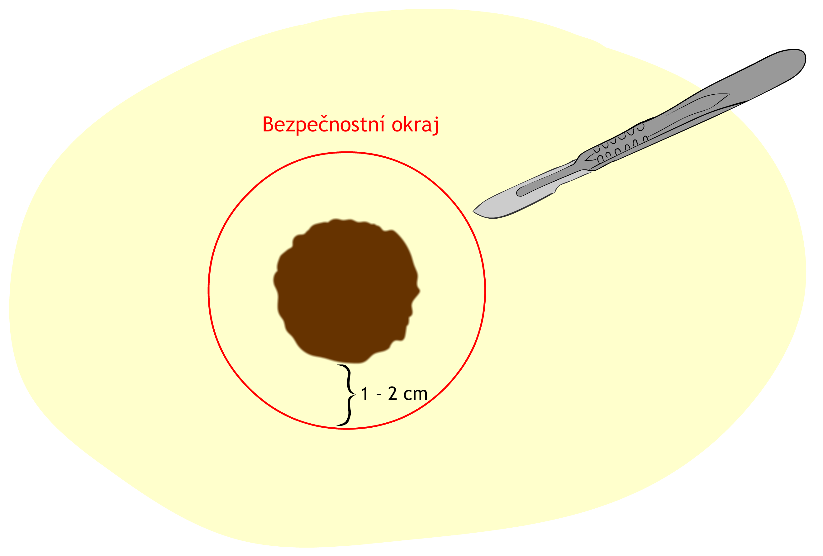 maligní melanom bezpečnostní okraj excize