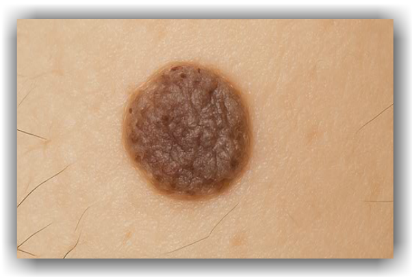 Seborhoická keratóza