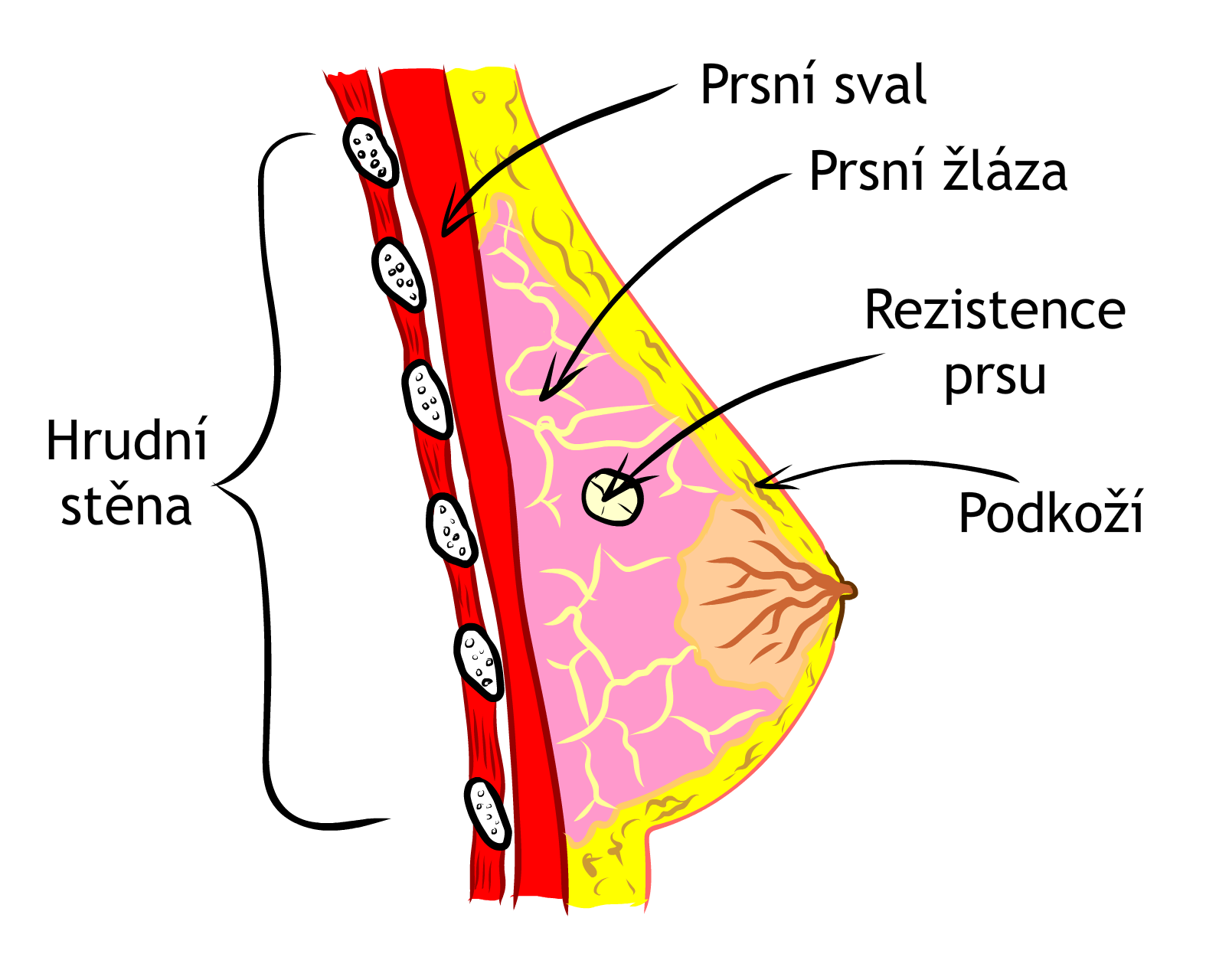 Průřez prsem s rezistencí