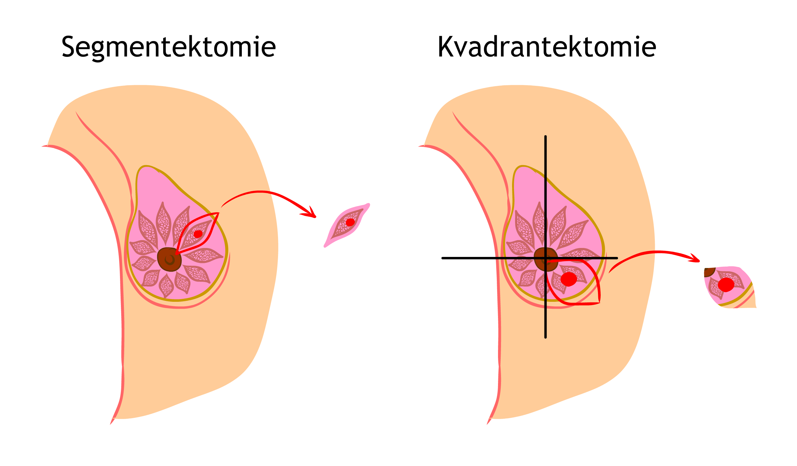 Segmentektomie a kvadrantektomie