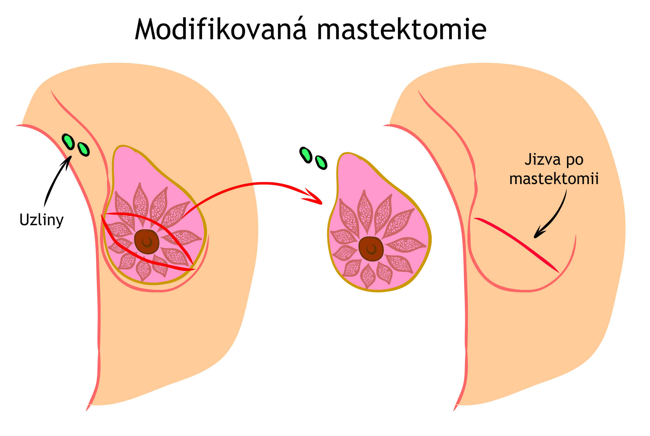 Modifikovaná mastektomie
