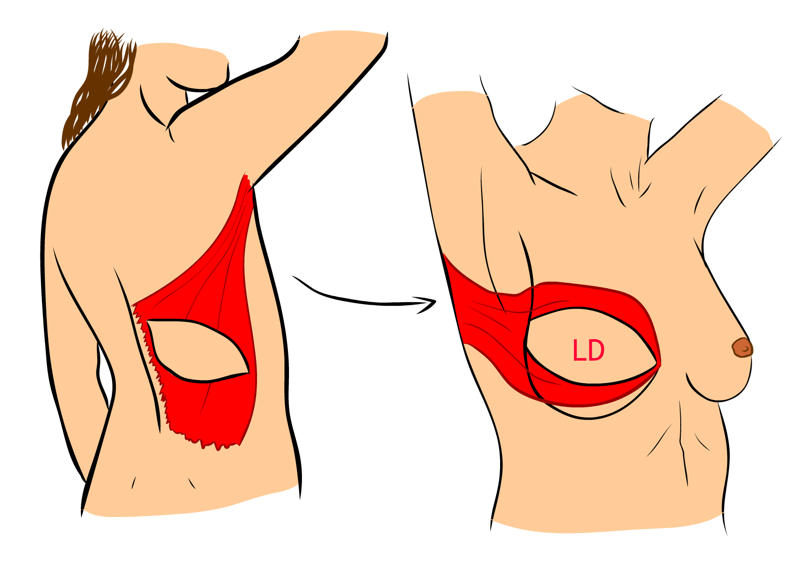 Rekonstrukce lalokem m. latissimus dorsi